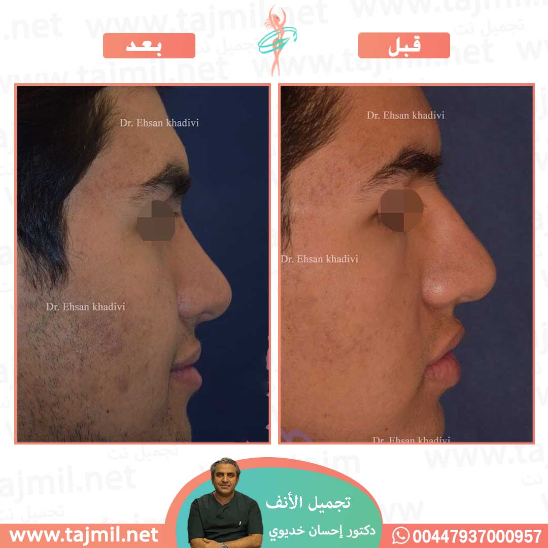  - دکتور إحسان خدیوي عملية تجميل الانف في ايران مع تجميل نت