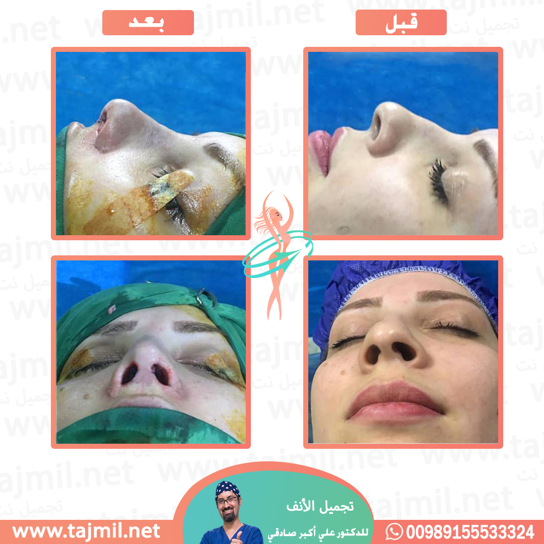  - دكتور احسان خديوي عملية تجميل الانف في ايران مع تجميل نت