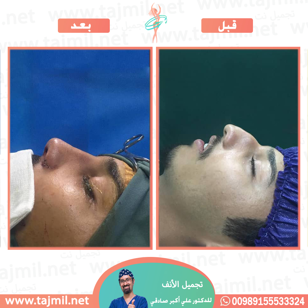  - دكتور احسان خديوي عملية تجميل الانف في ايران مع تجميل نت