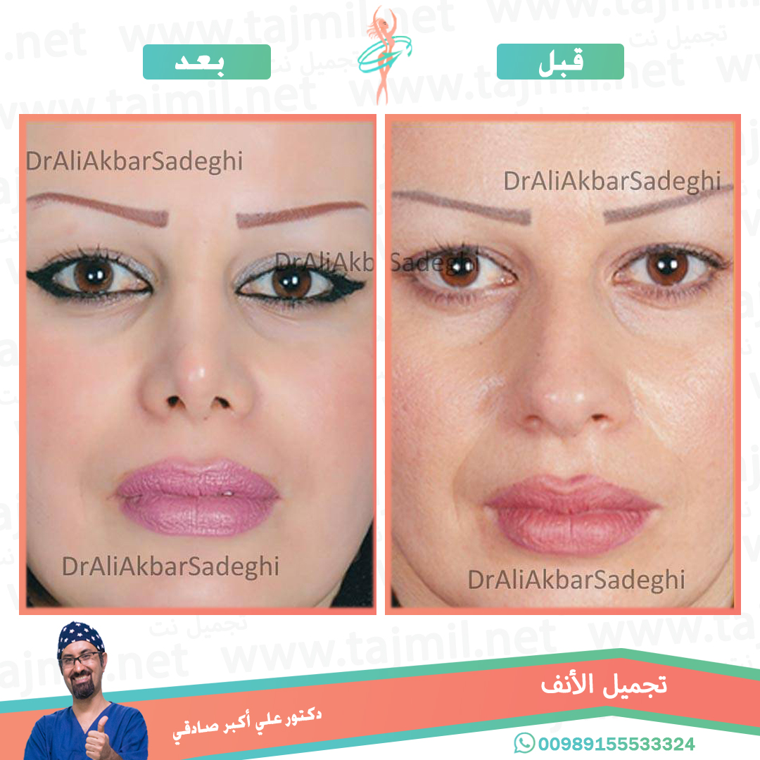  - دكتور علي أکبر صادقي عملية تجميل الانف في ايران مع تجميل نت