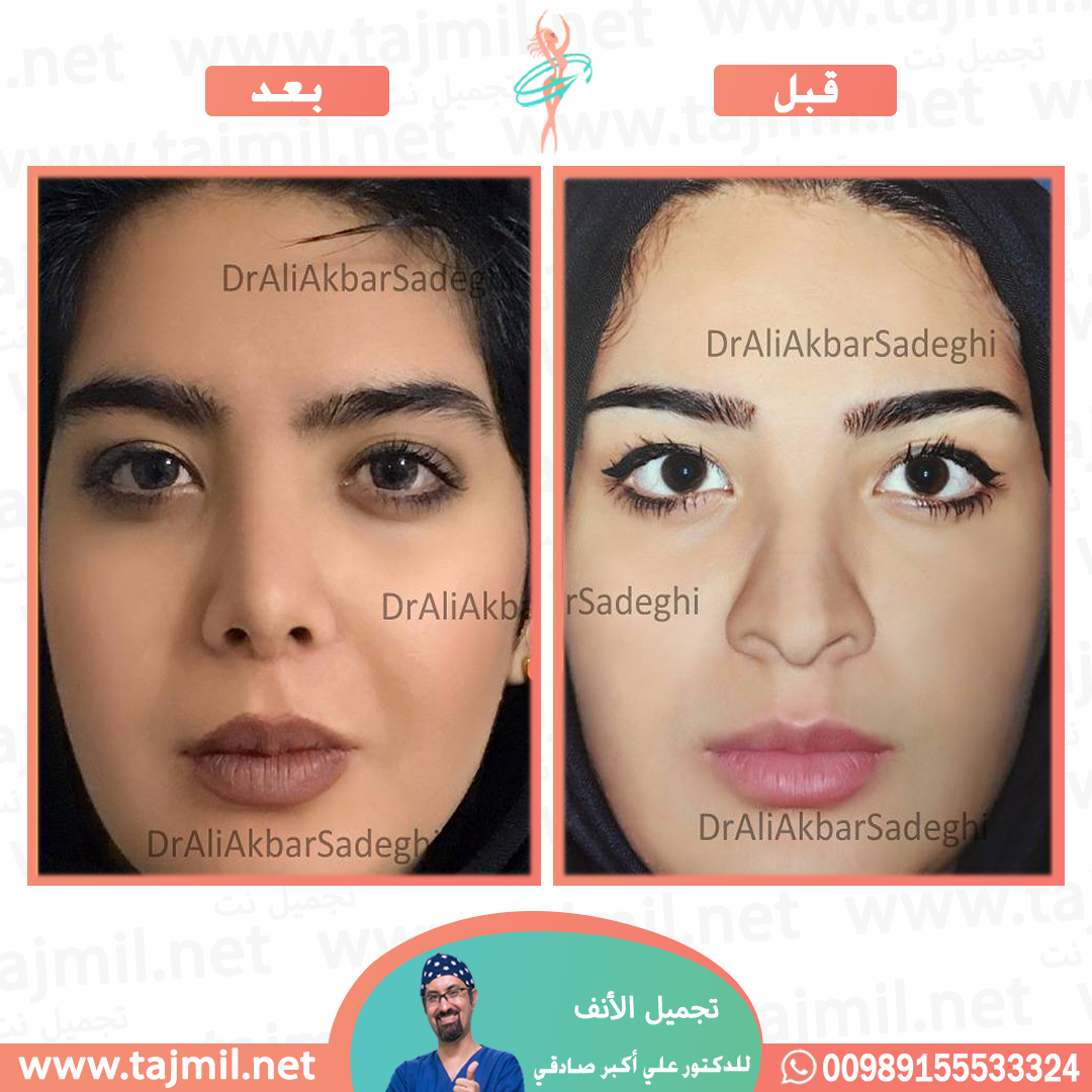  - دكتور علي أکبر صادقي عملية تجميل الانف في ايران مع تجميل نت