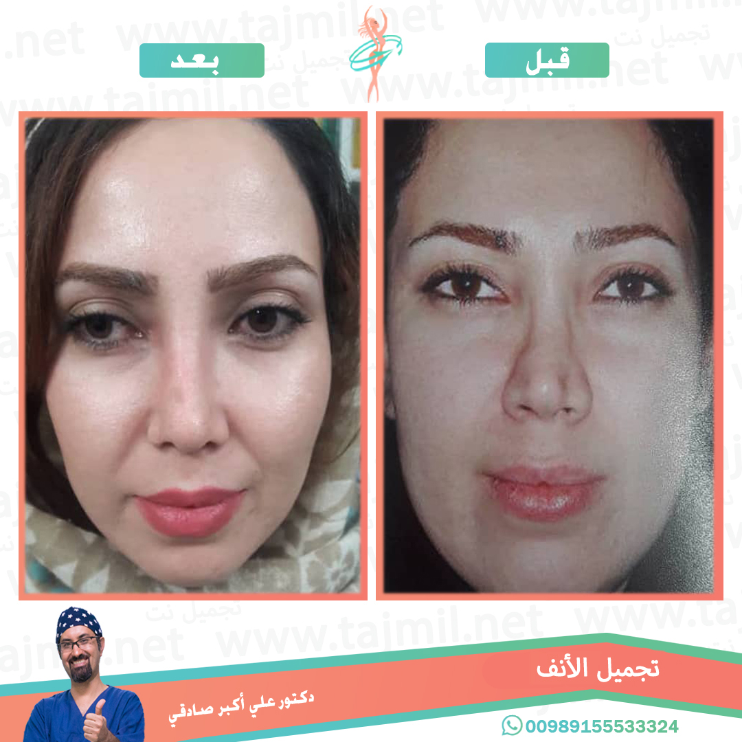  - دكتور احسان خديوي عملية تجميل الانف في ايران مع تجميل نت