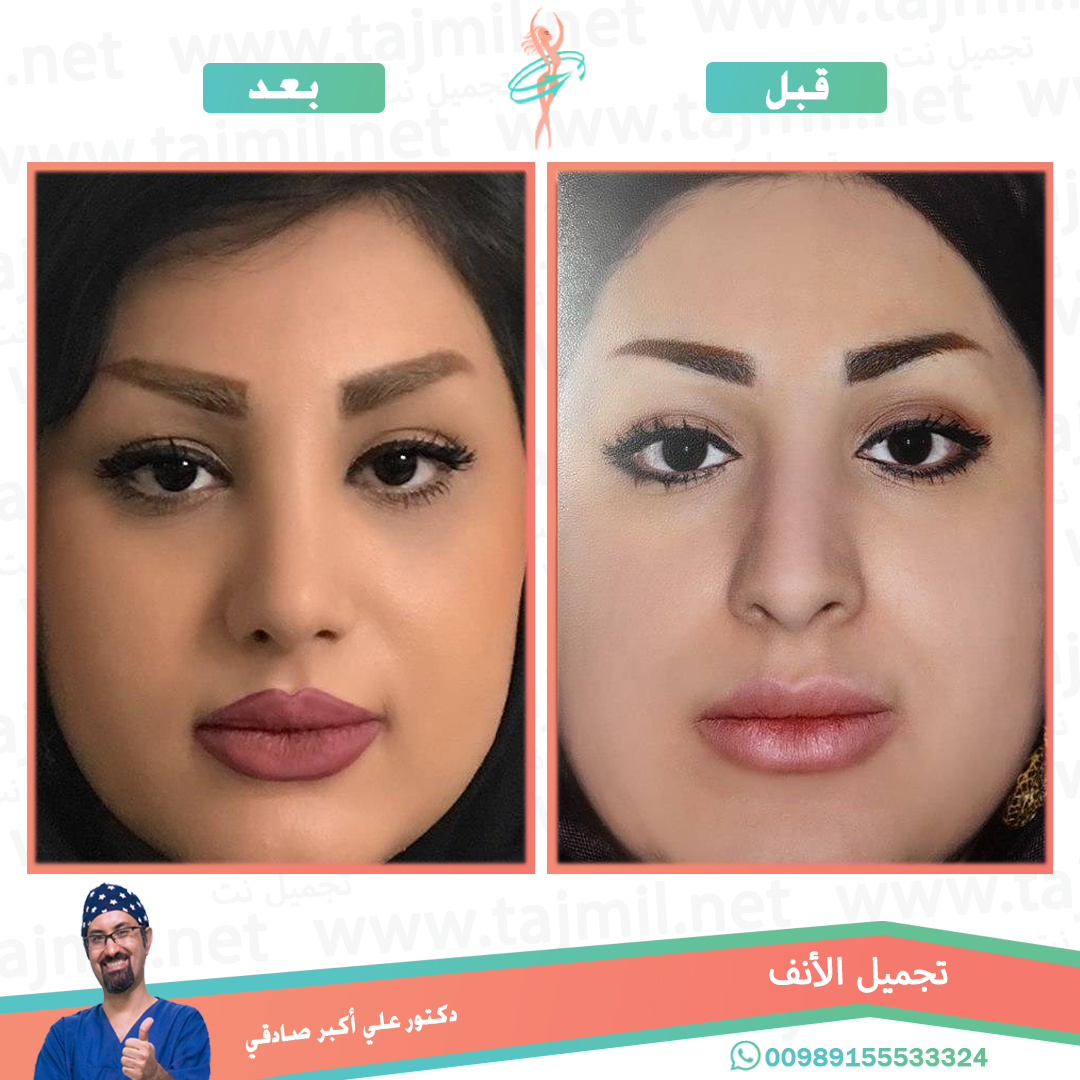  - دكتور احسان خديوي عملية تجميل الانف في ايران مع تجميل نت