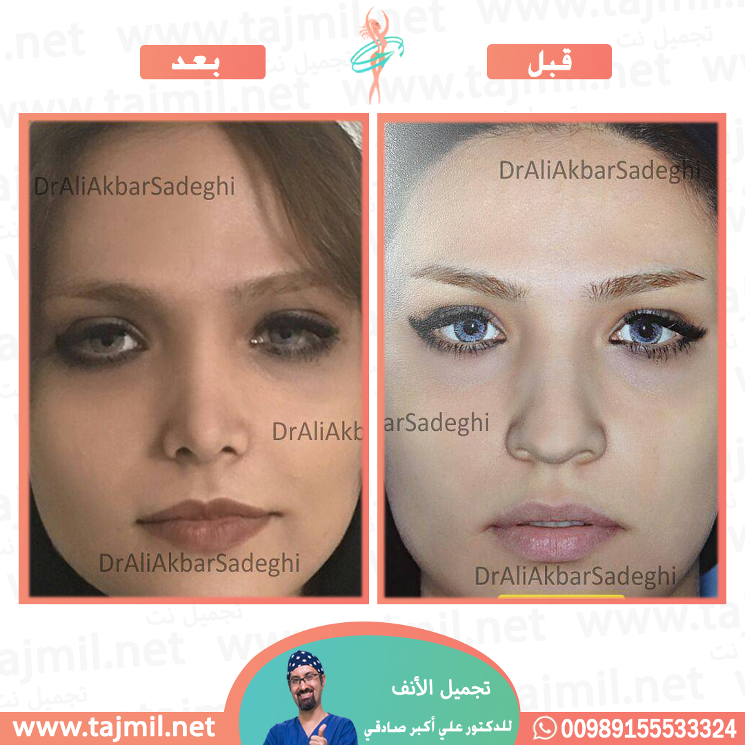  - دكتور علي أکبر صادقي عملية تجميل الانف في ايران مع تجميل نت