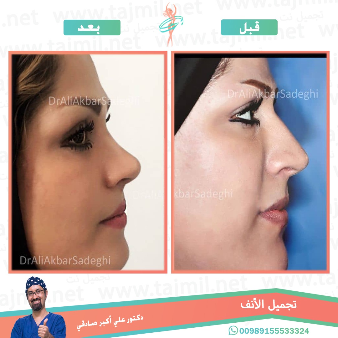  - دكتور علي أکبر صادقي عملية تجميل ألانف في ايران مع تجميل نت