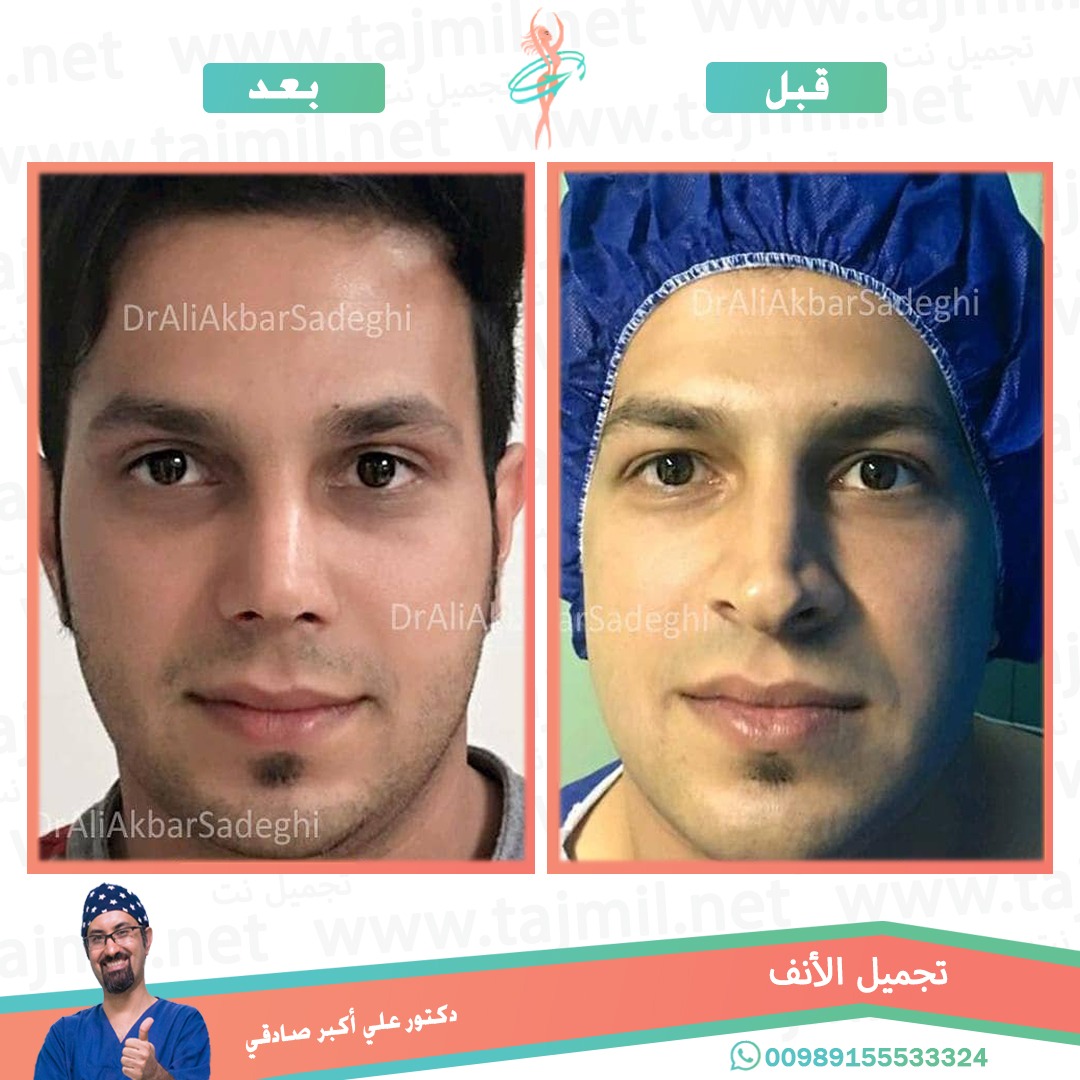  - دكتور علي أکبر صادقي عملية تجميل ألانف في ايران مع تجميل نت