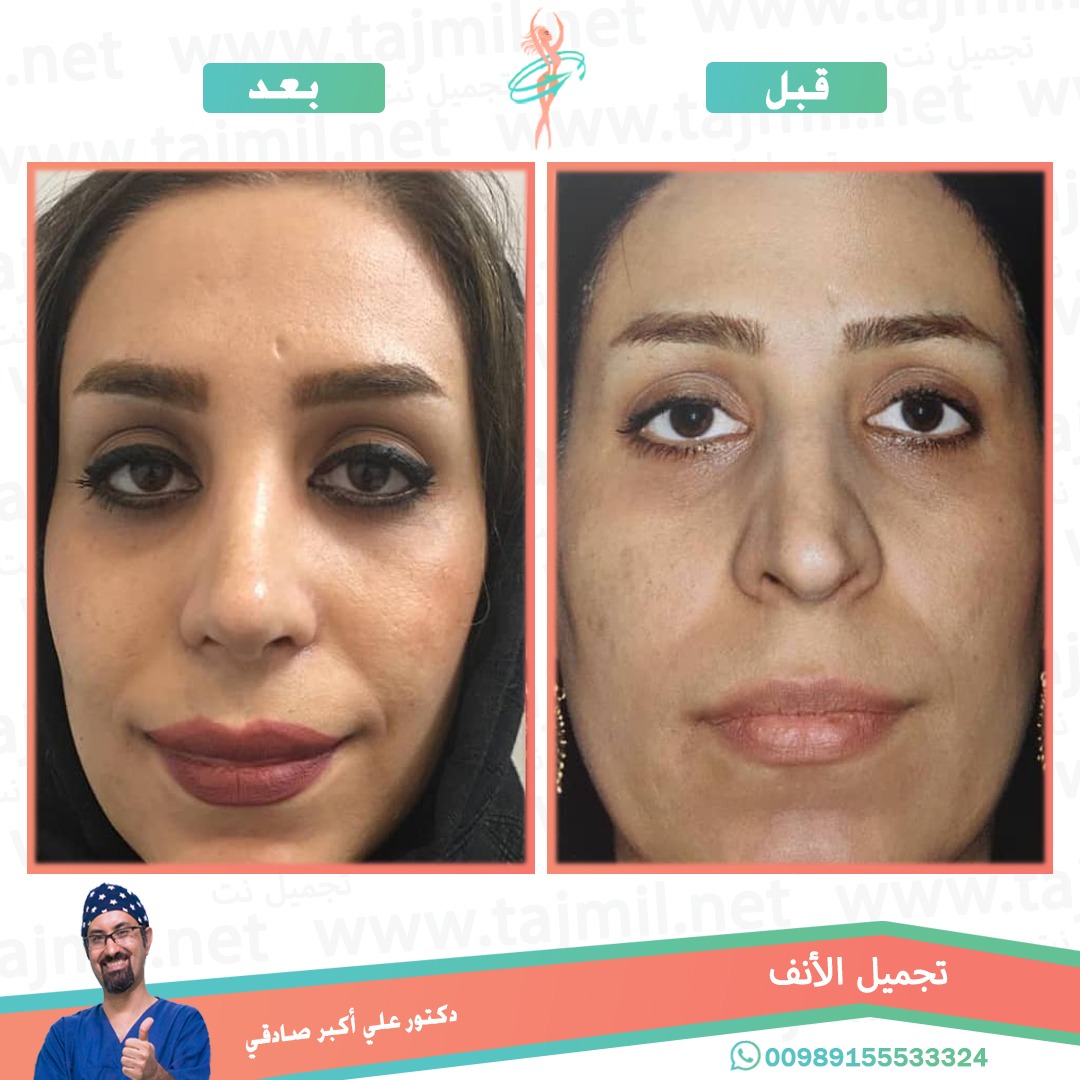  - دكتور علي أکبر صادقي عملية تجميل ألانف في ايران مع تجميل نت