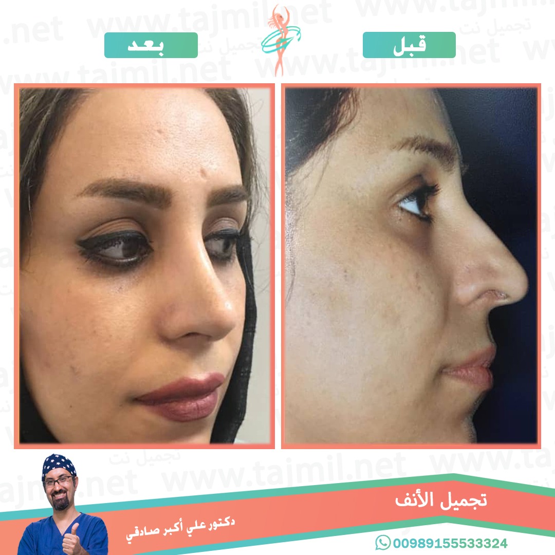  - دكتور علي أکبر صادقي عملية تجميل ألانف في ايران مع تجميل نت