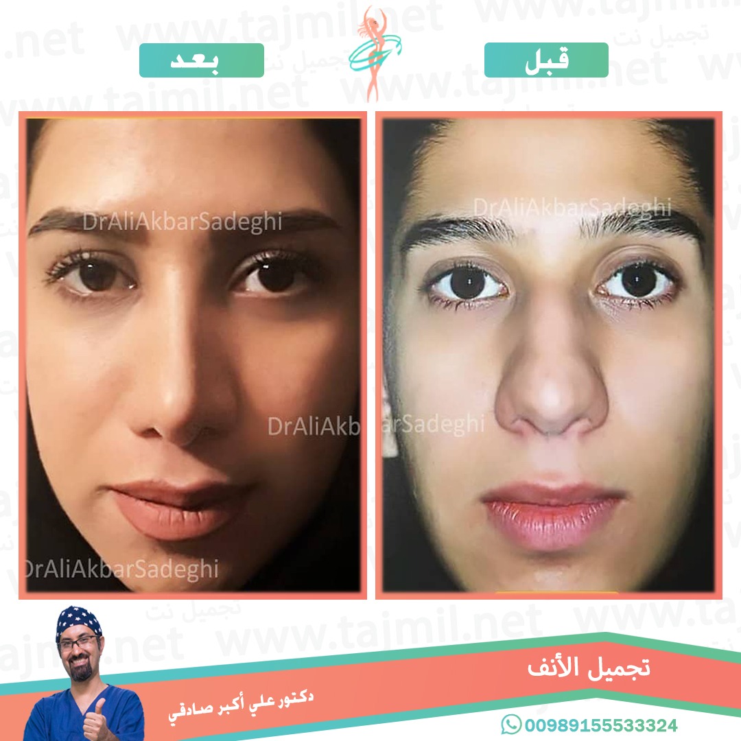  - دكتور علي أکبر صادقي عملية تجميل ألانف في ايران مع تجميل نت