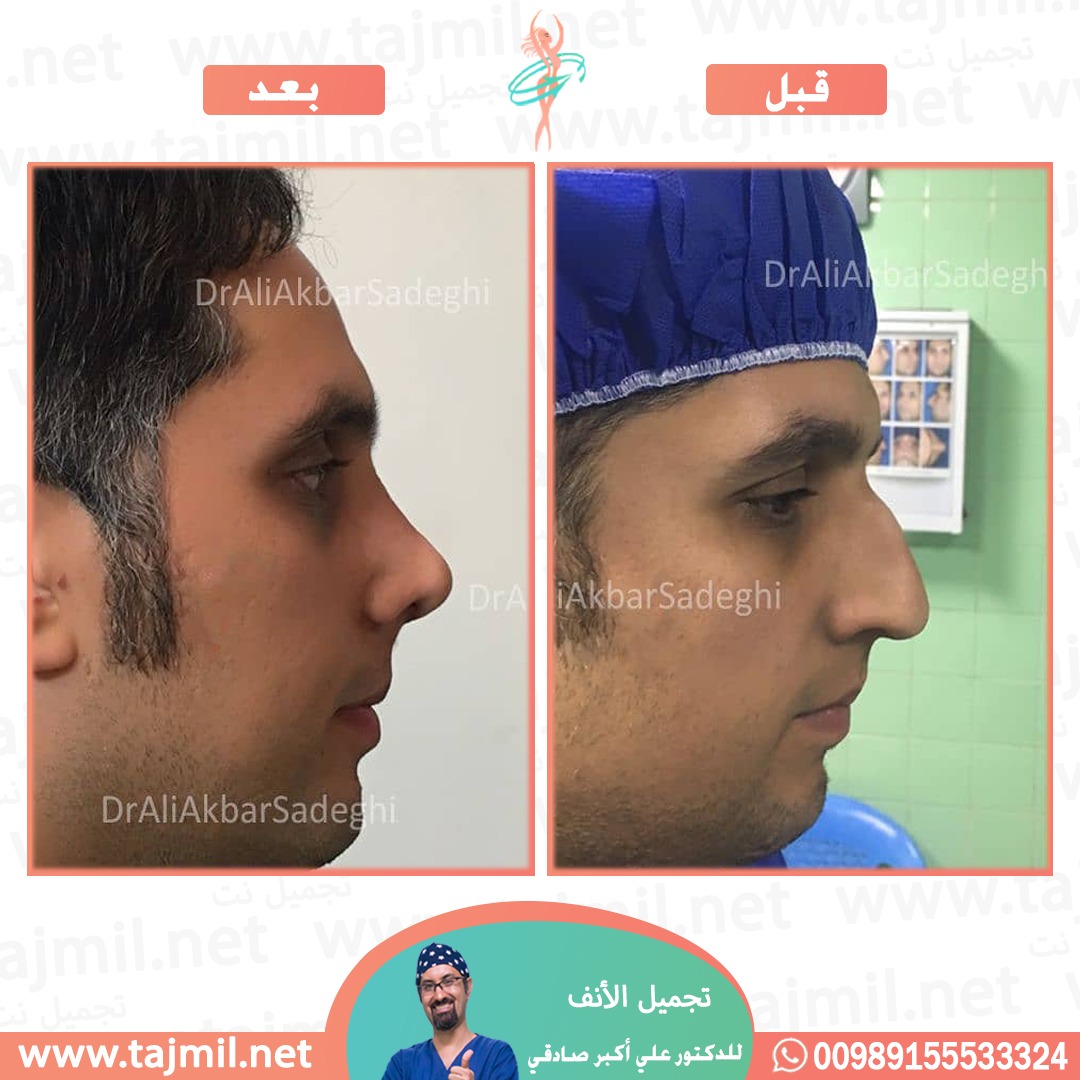  - دكتور علي أکبر صادقي عملية تجميل ألانف في ايران مع تجميل نت