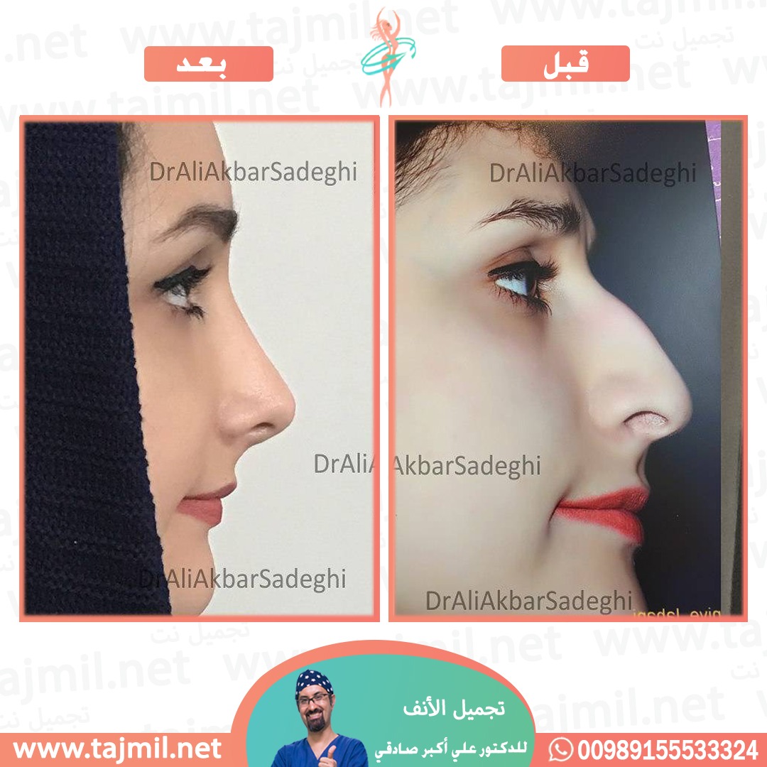  - دكتور علي أکبر صادقي عملية تجميل ألانف في ايران مع تجميل نت