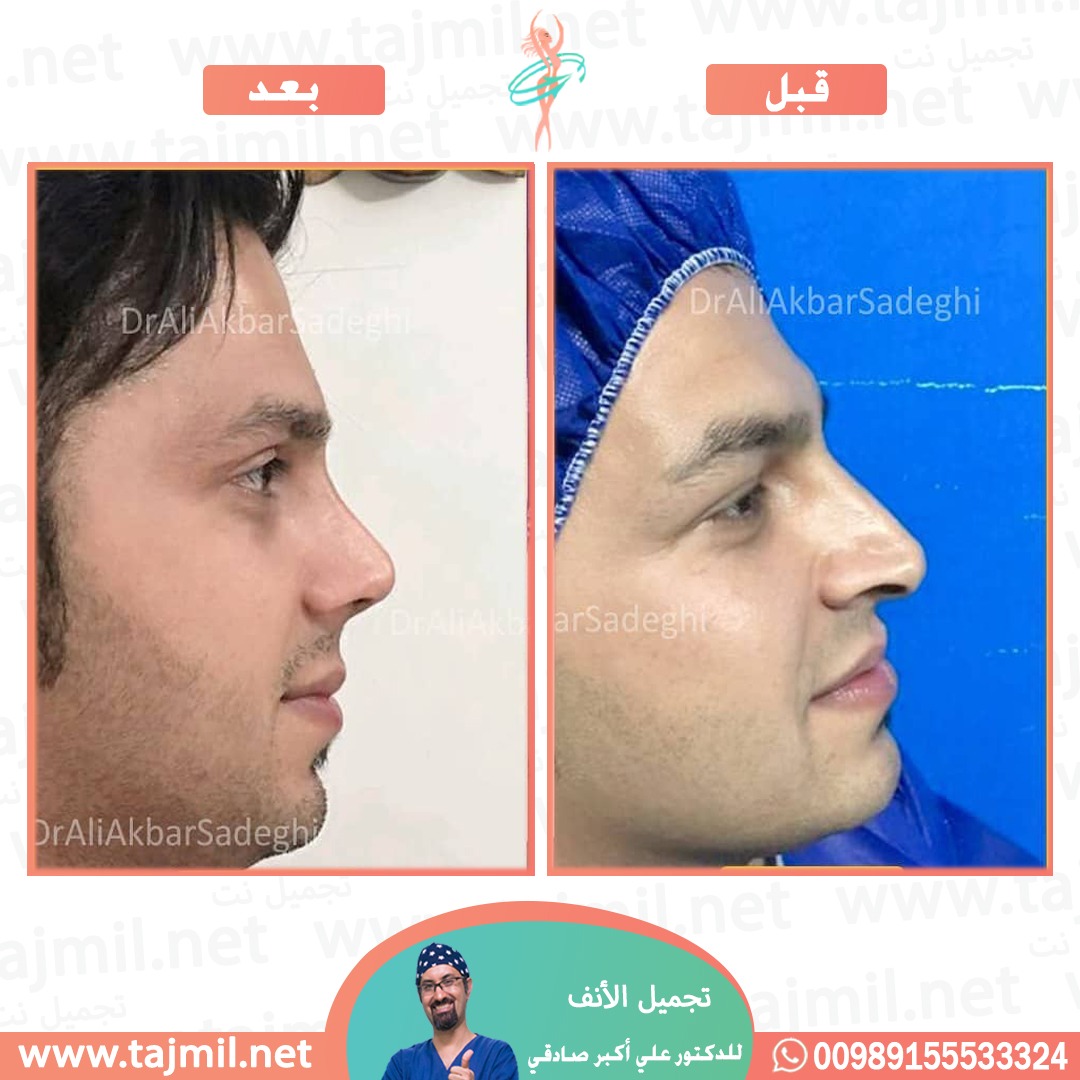  - دكتور علي أکبر صادقي عملية تجميل ألانف في ايران مع تجميل نت