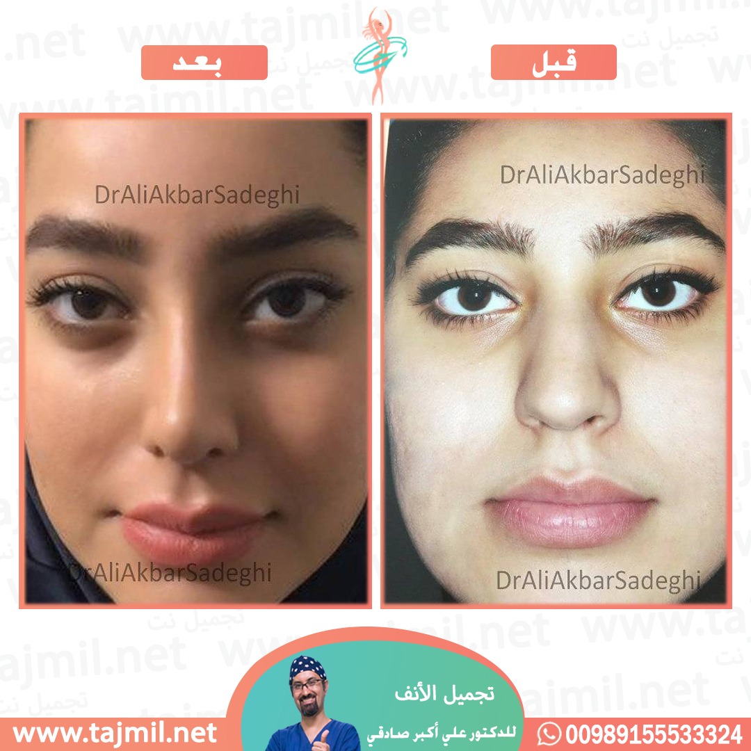  - دكتور علي أکبر صادقي عملية تجميل ألانف في ايران مع تجميل نت