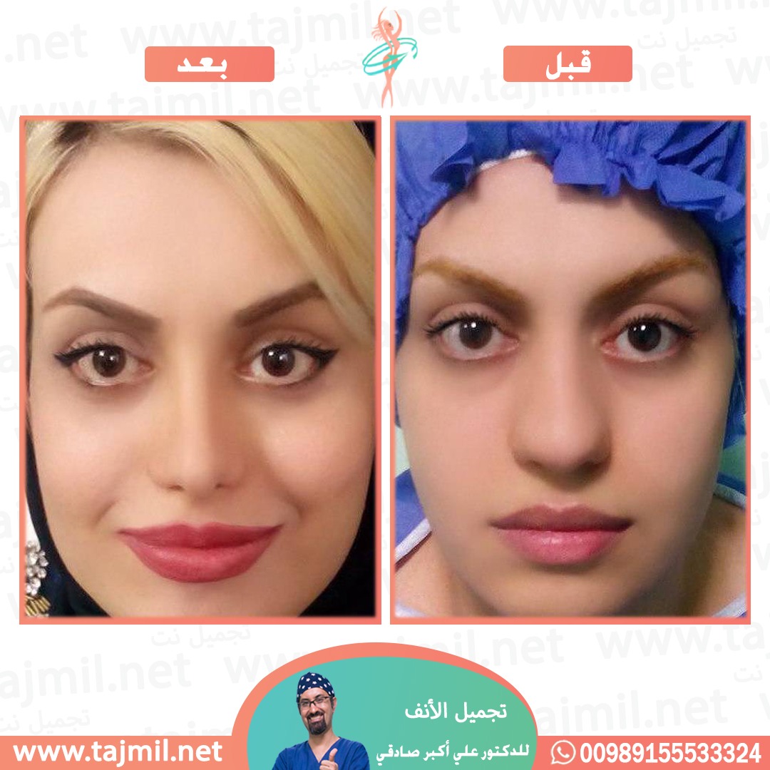  - دكتور علي أکبر صادقي عملية تجميل ألانف في ايران مع تجميل نت