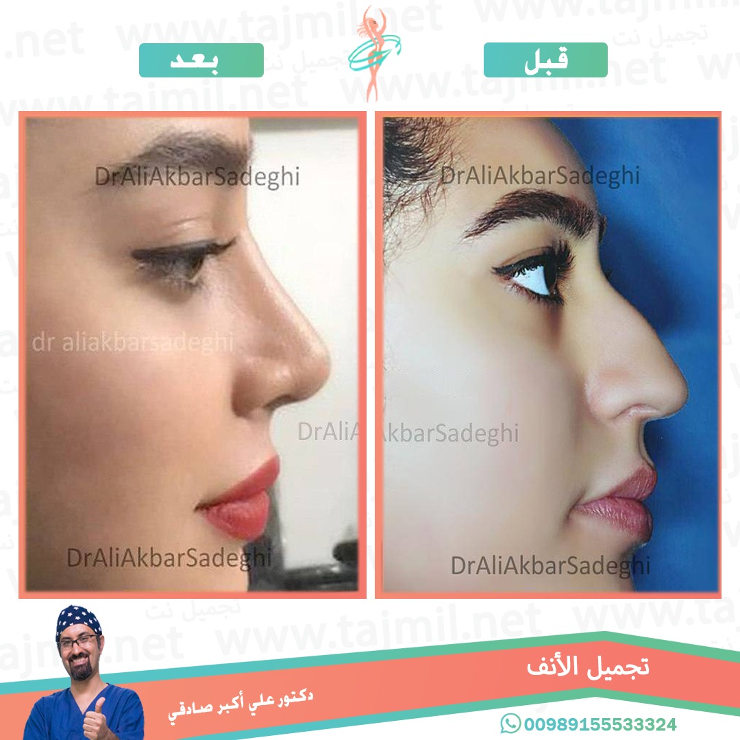  - دكتور علي أکبر صادقي عملية تجميل ألانف في ايران مع تجميل نت