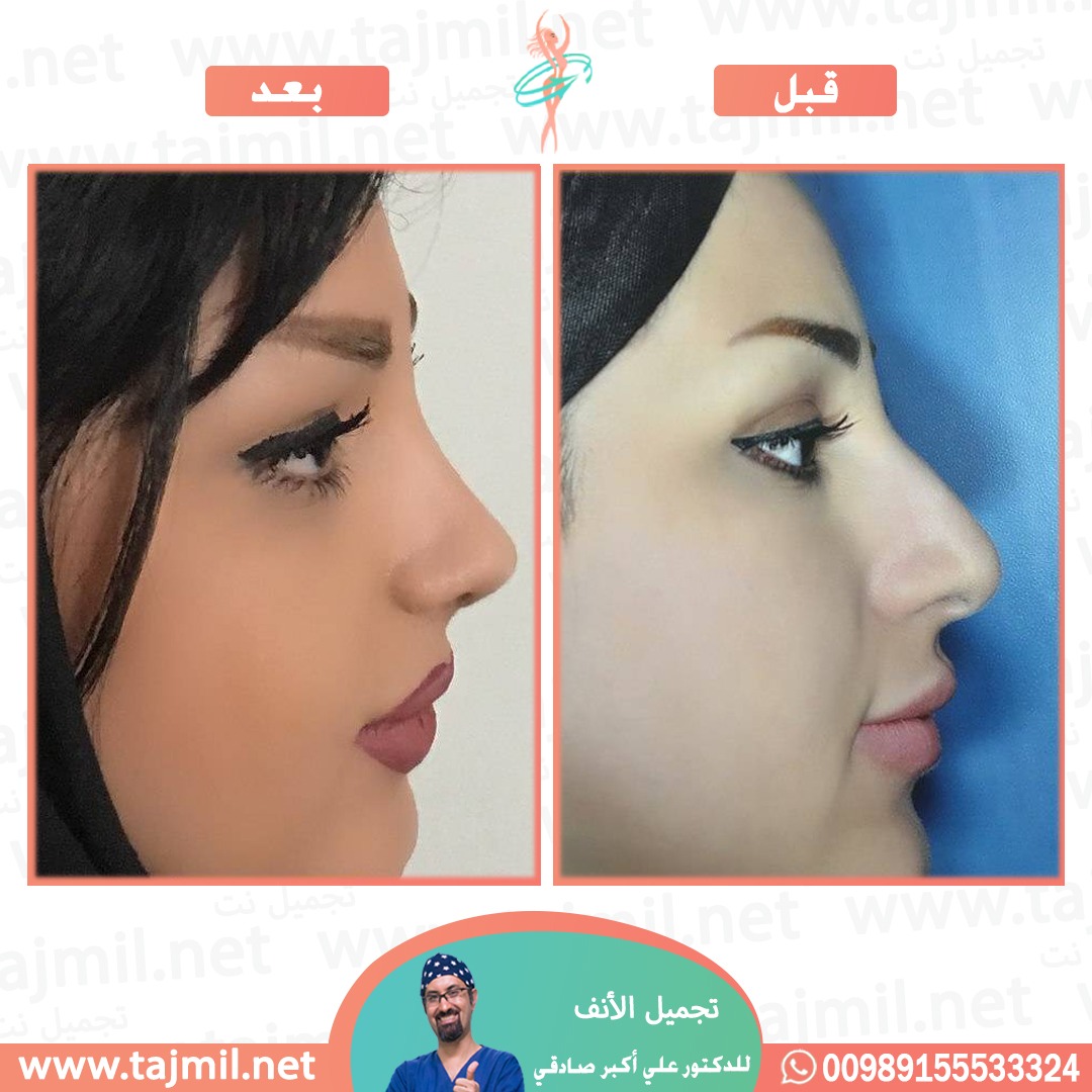  - دكتور علي أکبر صادقي عملية تجميل ألانف في ايران مع تجميل نت