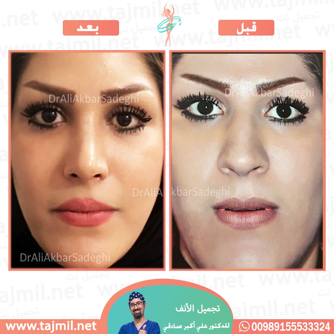  - دكتور علي أکبر صادقي عملية تجميل ألانف في ايران مع تجميل نت