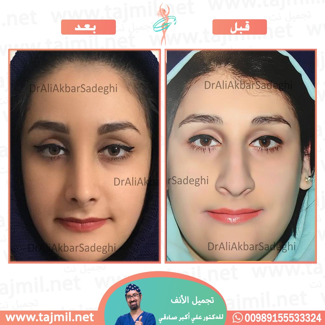  - دكتور علي أکبر صادقي عملية تجميل ألانف في ايران مع تجميل نت