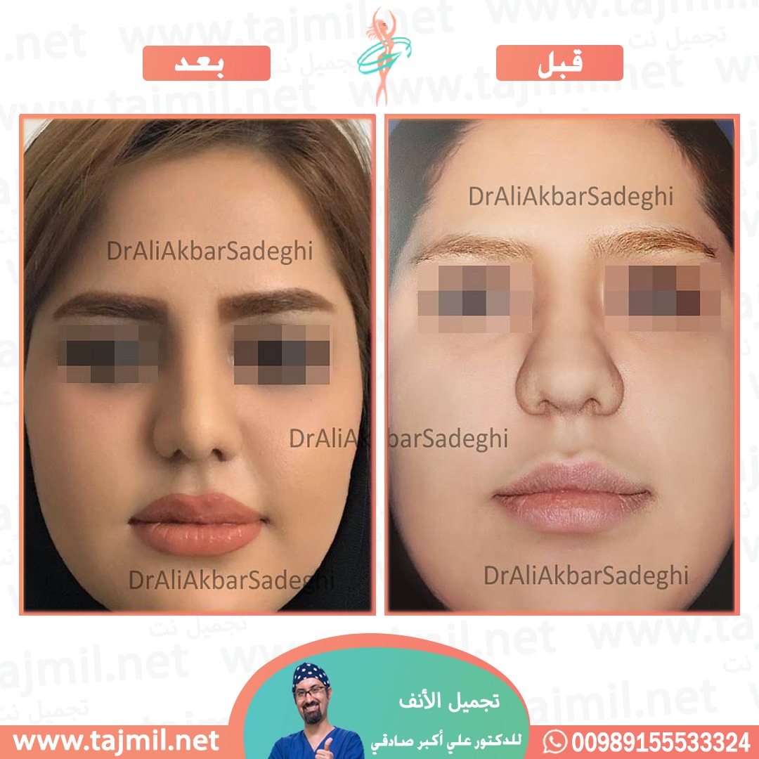  - دكتور علي أکبر صادقي عملية تجميل الانف في ايران مع تجميل نت