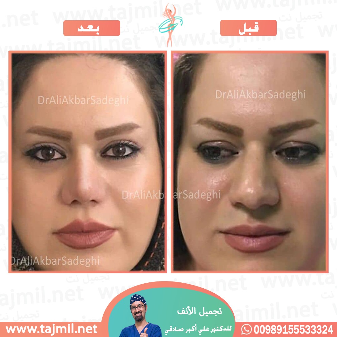  - دكتور علي أکبر صادقي عملية تجميل ألانف في ايران مع تجميل نت