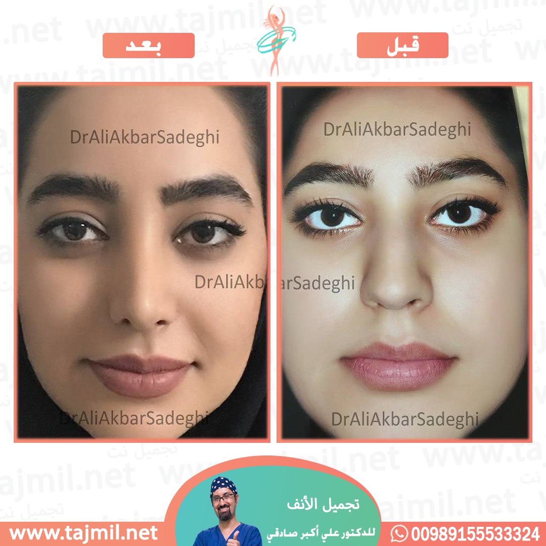  - دكتور علي أکبر صادقي عملية تجميل ألانف في ايران مع تجميل نت