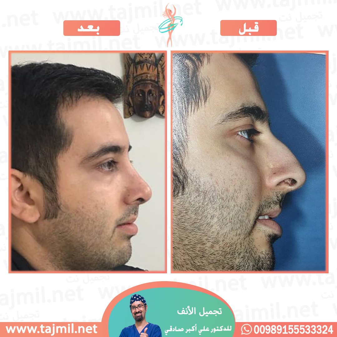  - دكتور علي أکبر صادقي عملية تجميل ألانف في ايران مع تجميل نت