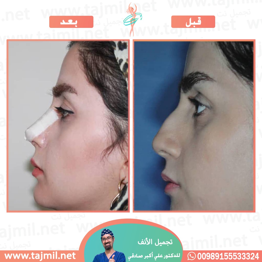  - دكتور علي أکبر صادقي عملية تجميل ألانف في ايران مع تجميل نت