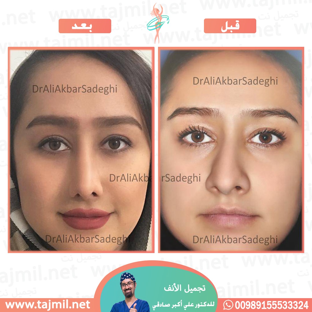  - دكتور علي أکبر صادقي عملية تجميل ألانف في ايران مع تجميل نت