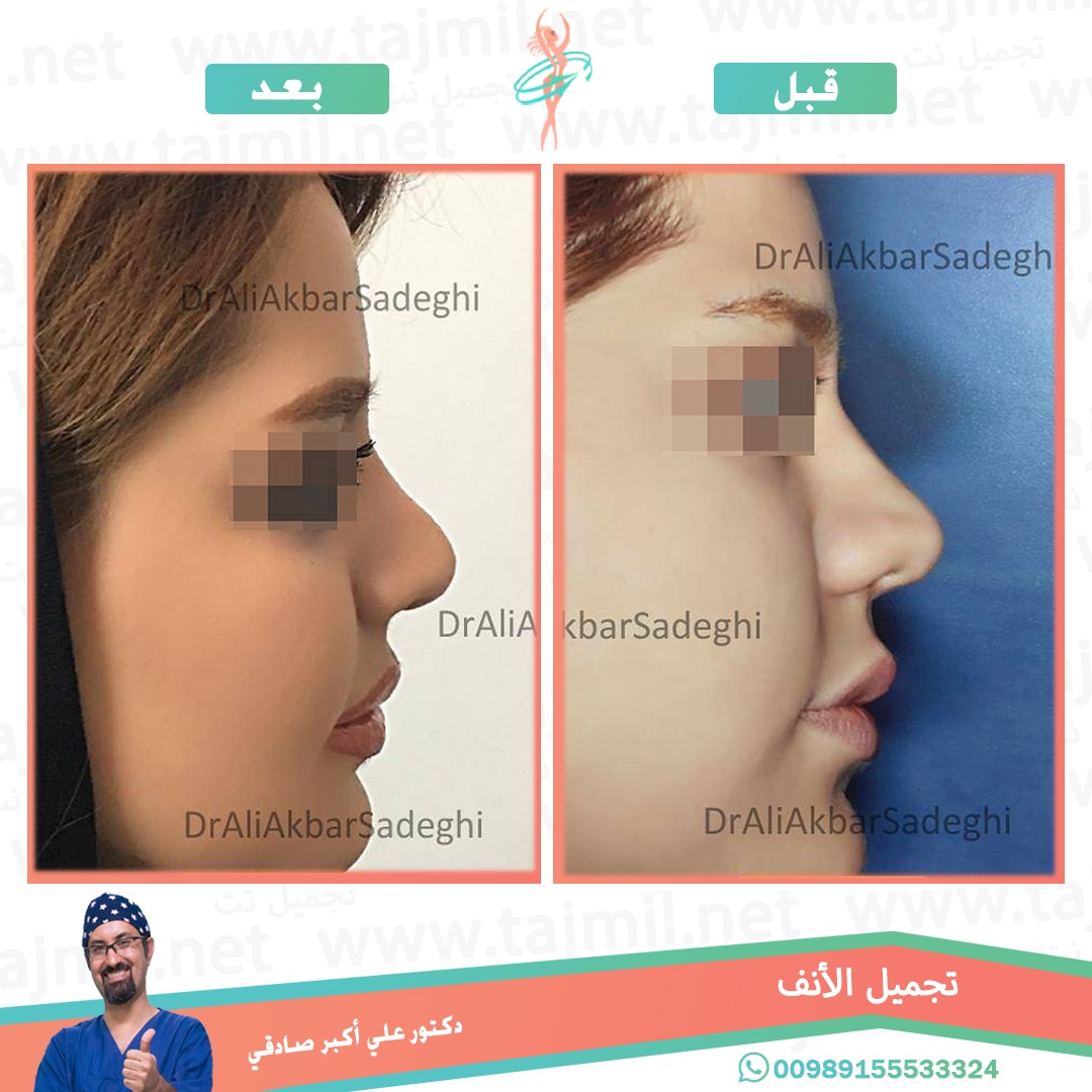  - دكتور علي أکبر صادقي عملية تجميل الانف في ايران مع تجميل نت