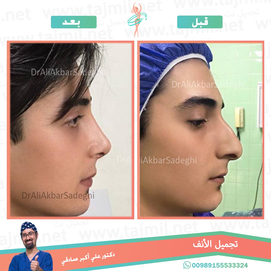  - دكتور علي أکبر صادقي عملية تجميل الانف في ايران مع تجميل نت