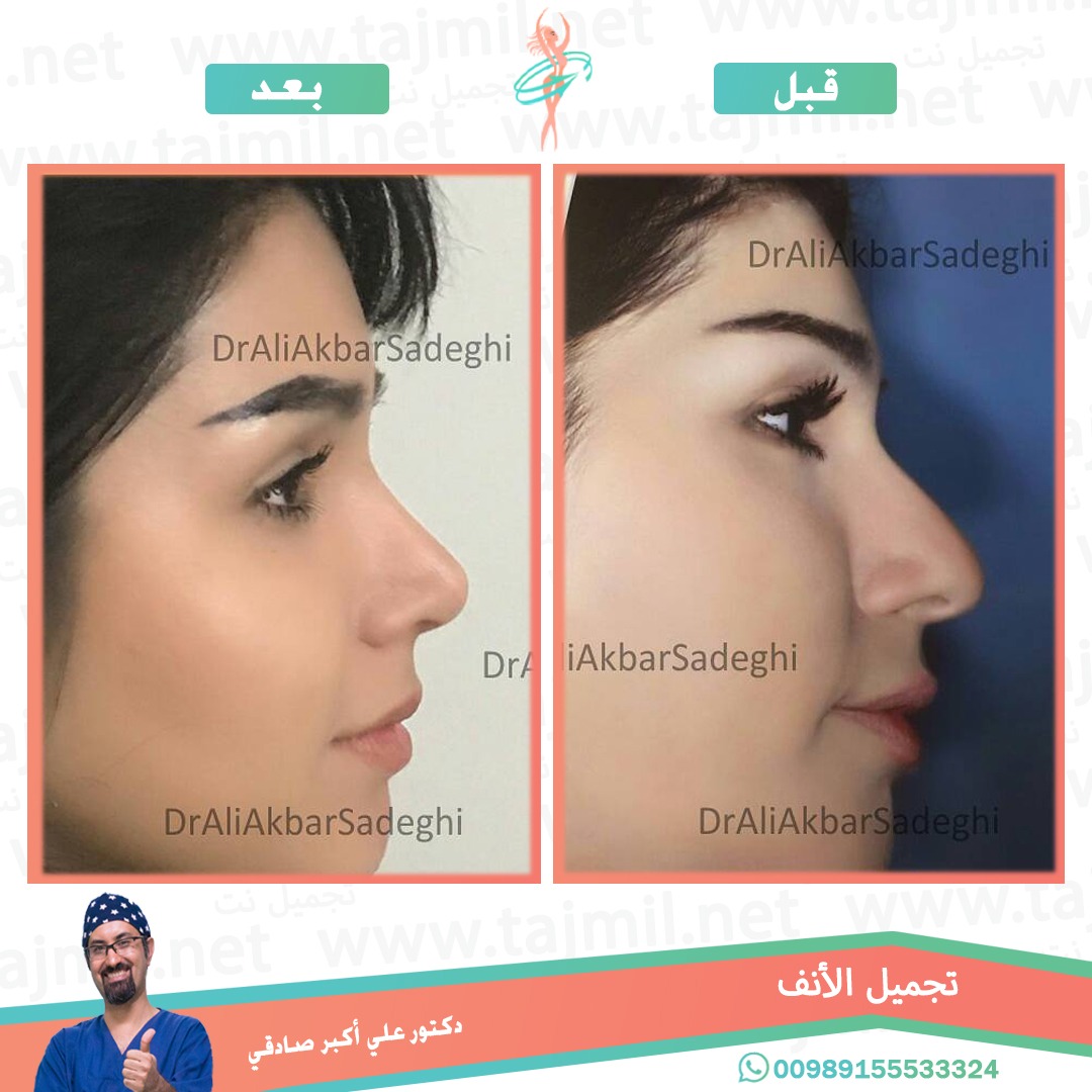  - دكتور علي أکبر صادقي عملية تجميل الانف في ايران مع تجميل نت