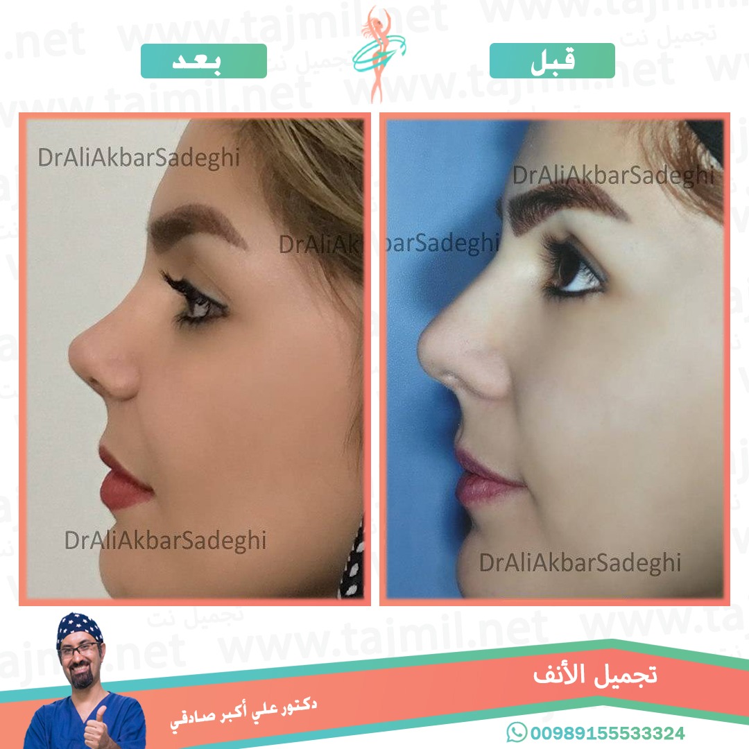  - دكتور علي أکبر صادقي عملية تجميل الانف في ايران مع تجميل نت