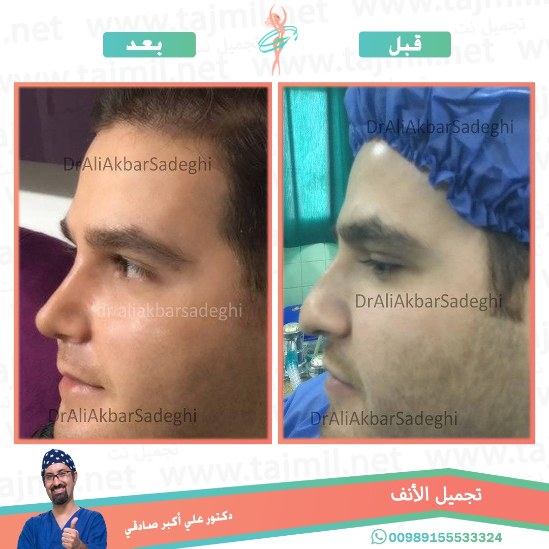  - دكتور علي أکبر صادقي عملية تجميل الانف في ايران مع تجميل نت