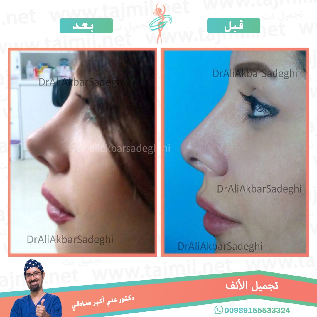  - دكتور علي أکبر صادقي عملية تجميل الانف في ايران مع تجميل نت