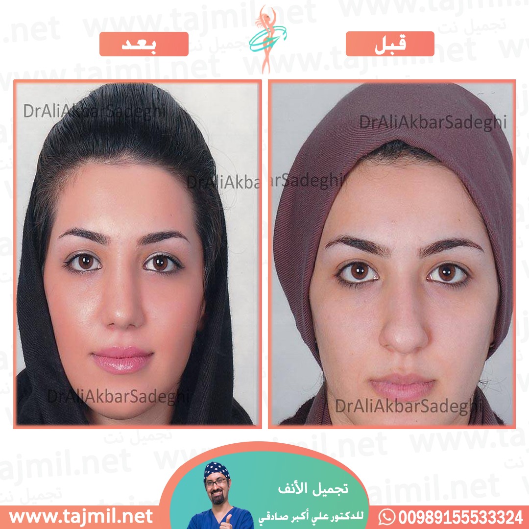  - دكتور علي أکبر صادقي عملية تجميل الانف في ايران مع تجميل نت