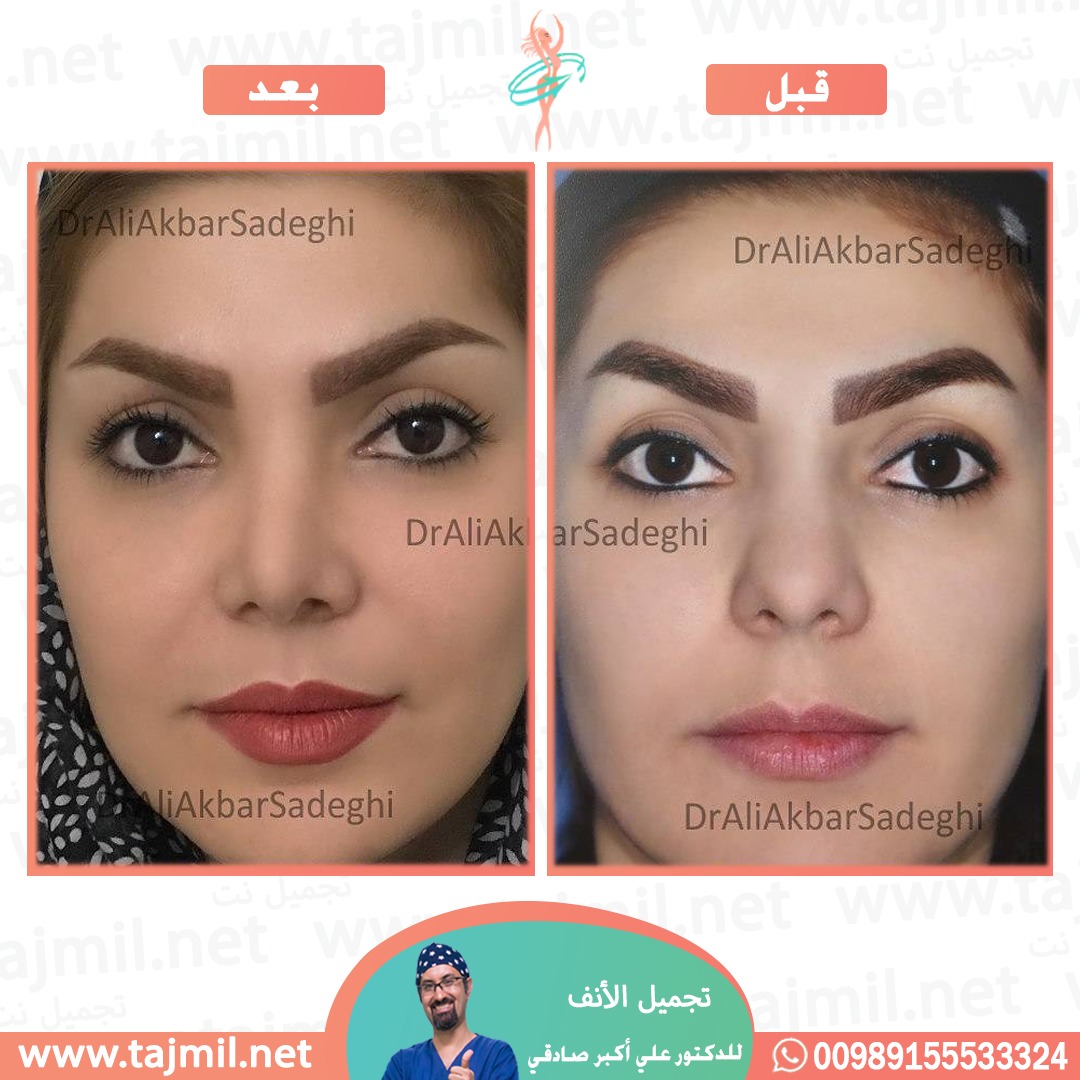  - دكتور علي أکبر صادقي عملية تجميل الانف في ايران مع تجميل نت