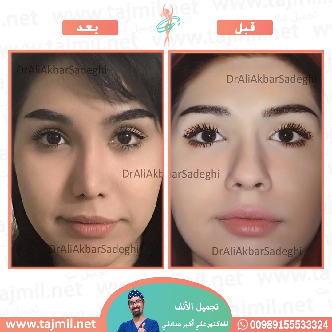  - دكتور علي أکبر صادقي عملية تجميل الانف في ايران مع تجميل نت