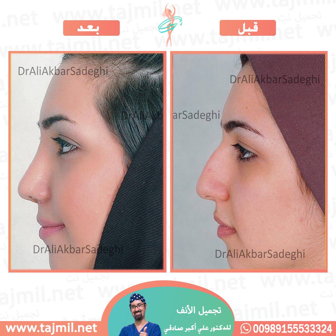  - دكتور علي أکبر صادقي عملية تجميل الانف في ايران مع تجميل نت