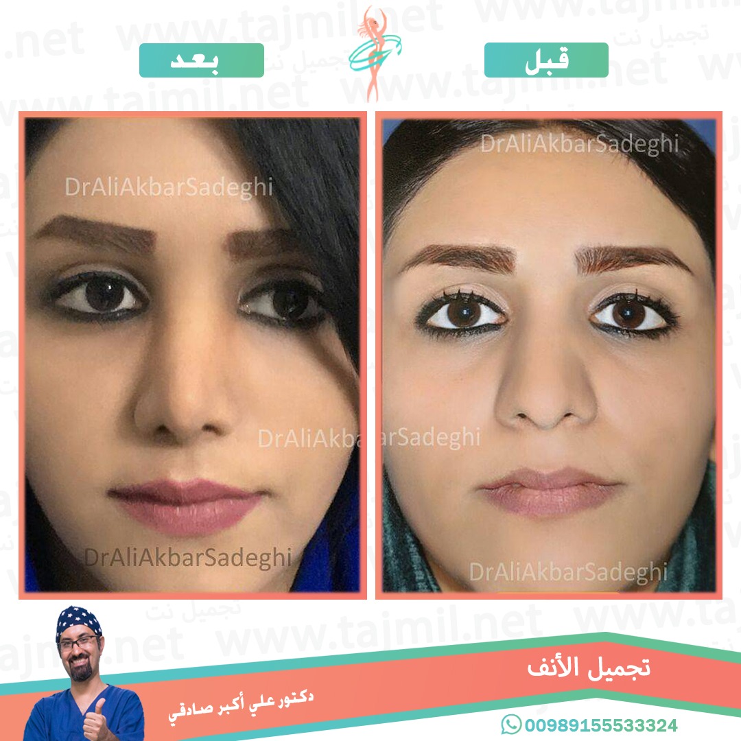  - دكتور علي أکبر صادقي عملية تجميل الانف في ايران مع تجميل نت