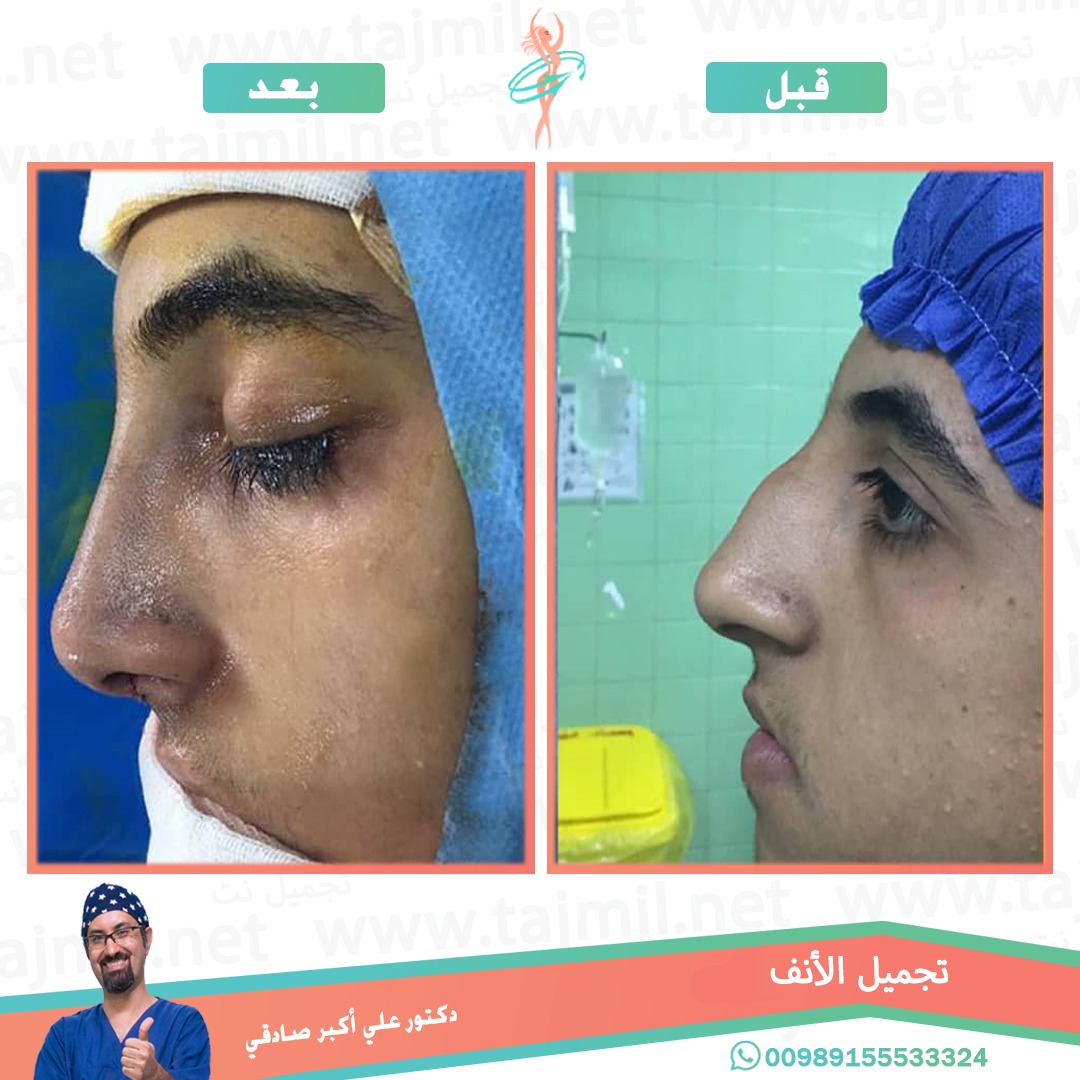  - دكتور علي أکبر صادقي عملية تجميل الانف في ايران مع تجميل نت