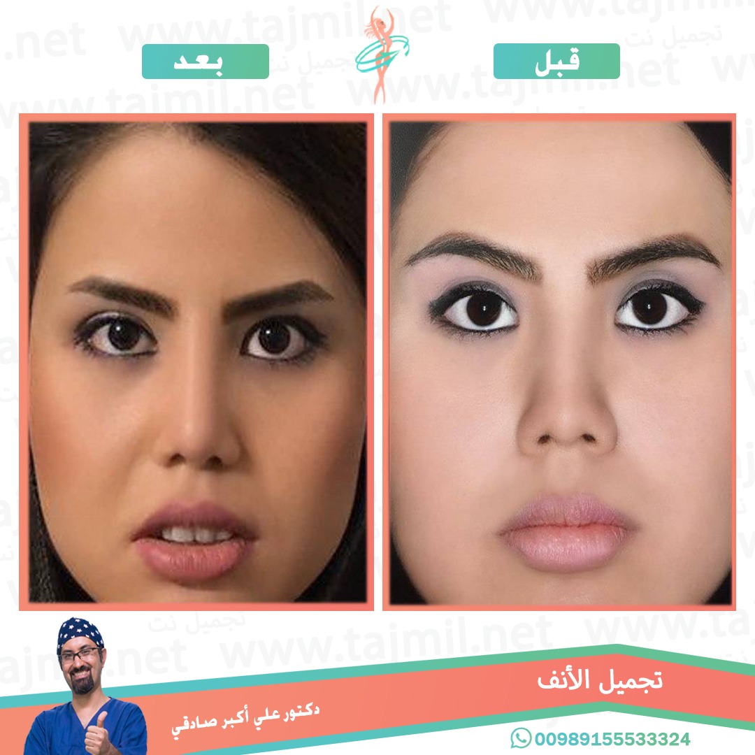  - دكتور علي أکبر صادقي عملية تجميل الانف في ايران مع تجميل نت