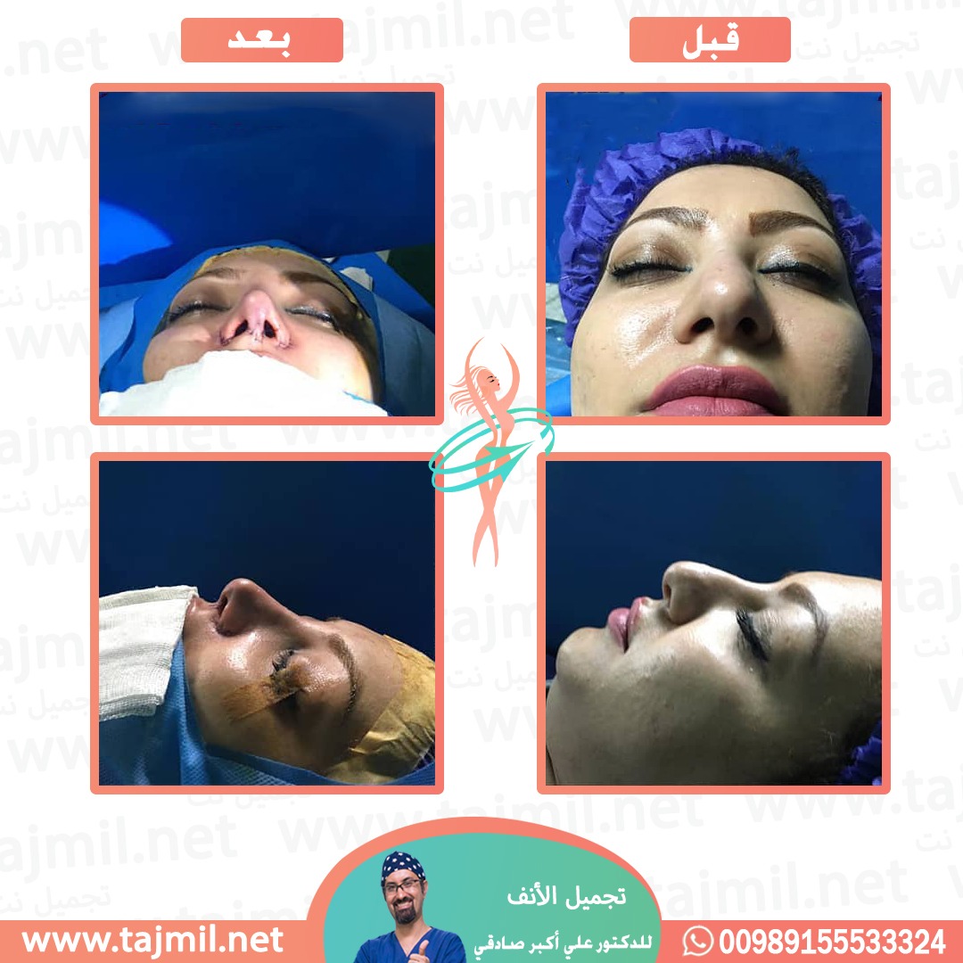  - دكتور علي أکبر صادقي عملية تجميل الانف في ايران مع تجميل نت