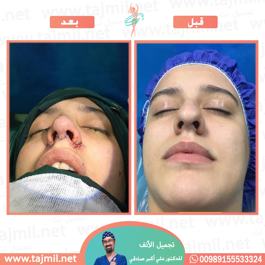  - دكتور علي أکبر صادقي عملية تجميل الانف في ايران مع تجميل نت