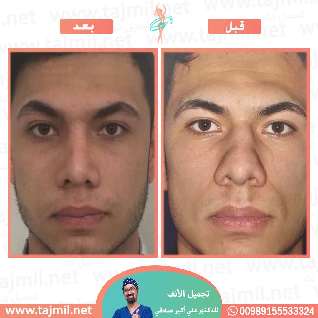  - دكتور علي أکبر صادقي عملية تجميل الانف في ايران مع تجميل نت