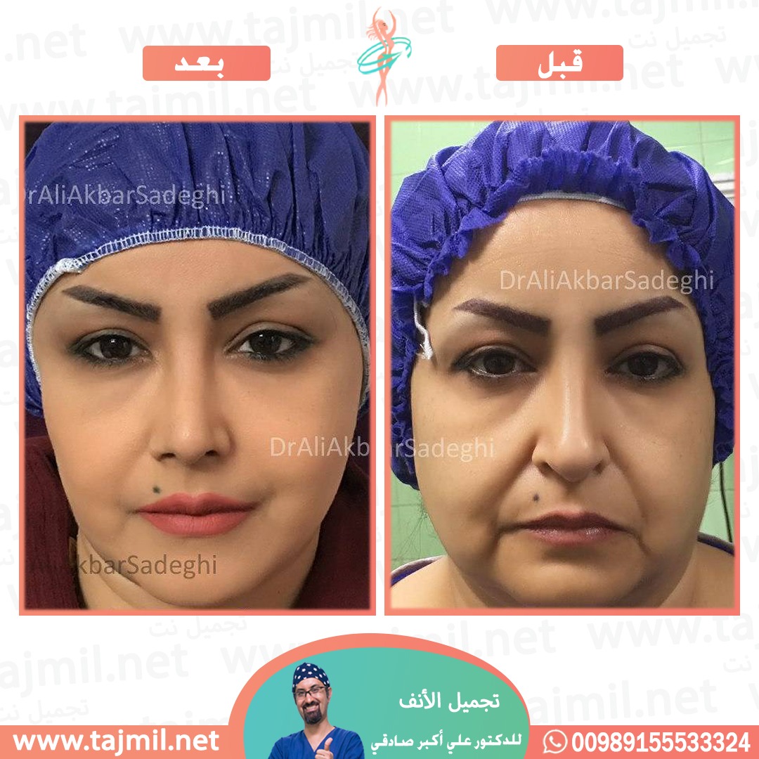  - دكتور علي أکبر صادقي عملية تجميل الانف في ايران مع تجميل نت