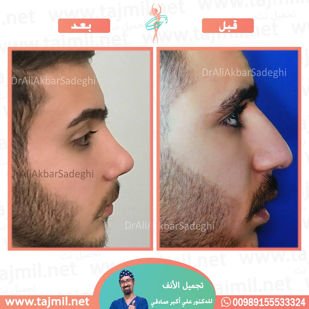  - دكتور علي أکبر صادقي عملية تجميل الانف في ايران مع تجميل نت