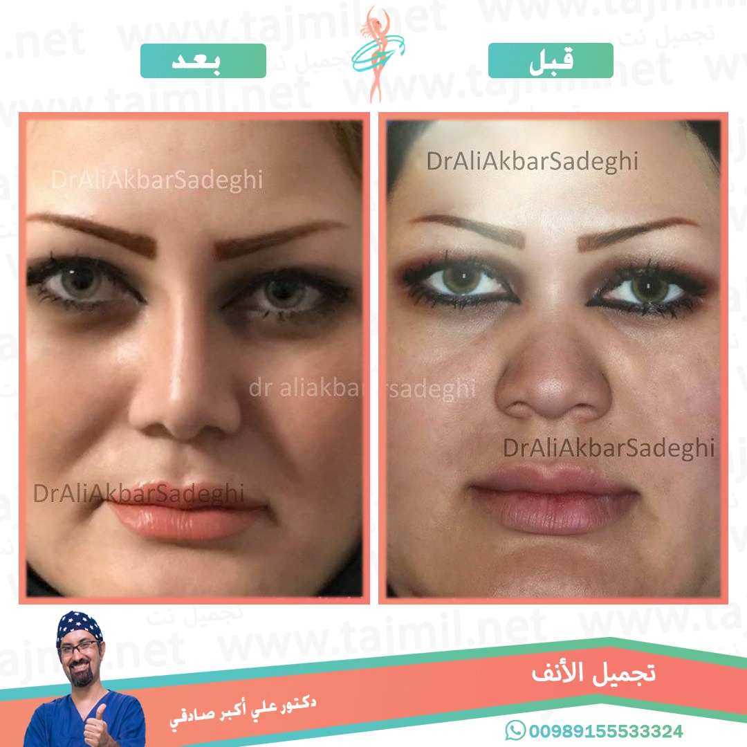  - دكتور علي أکبر صادقي عملية تجميل الانف في ايران مع تجميل نت