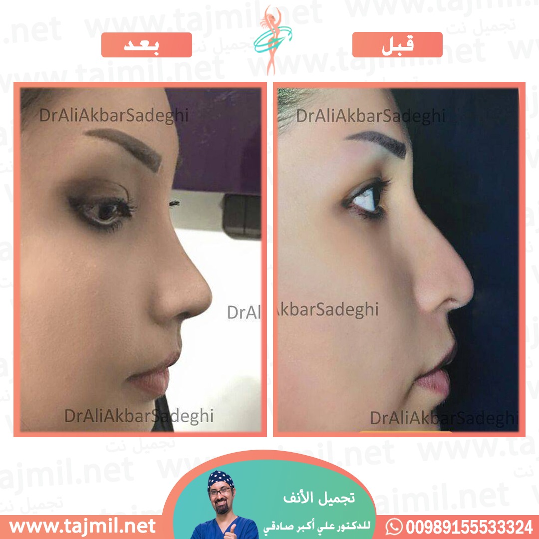  - دكتور علي أکبر صادقي عملية تجميل الانف في ايران مع تجميل نت