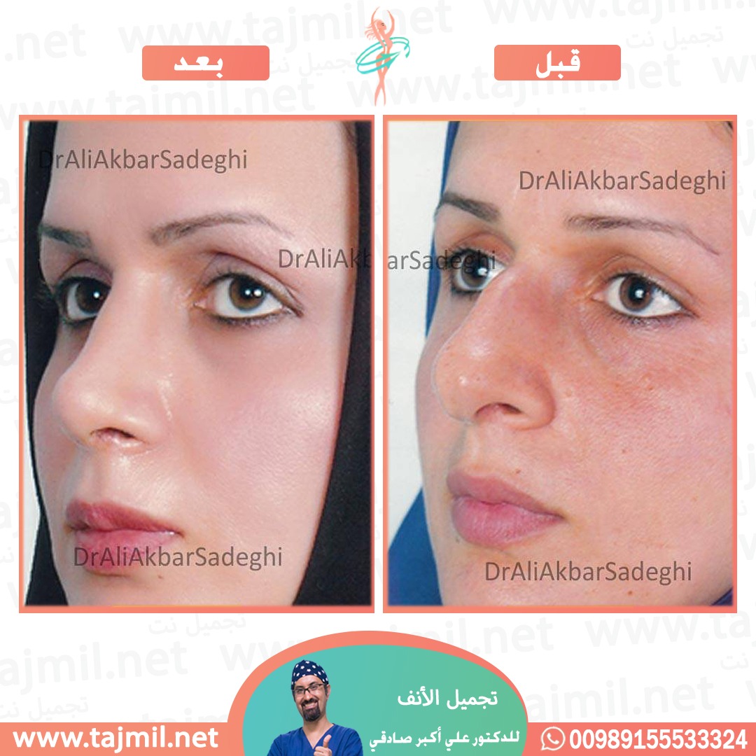  - دكتور علي أکبر صادقي عملية تجميل الانف في ايران مع تجميل نت