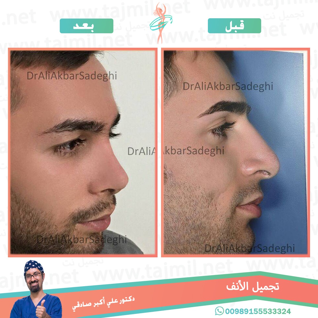  - دكتور علي أکبر صادقي عملية تجميل الانف في ايران مع تجميل نت